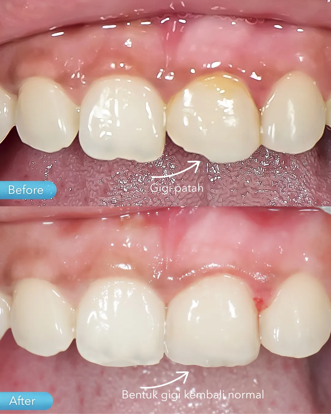 Dental filling result